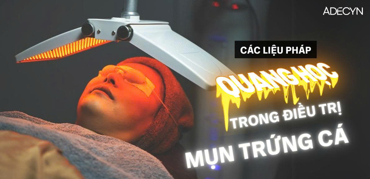 Các liệu pháp quang học trong điều trị Trứng cá