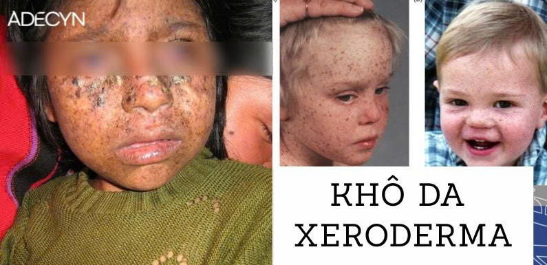 Khô da( Xeroderma)