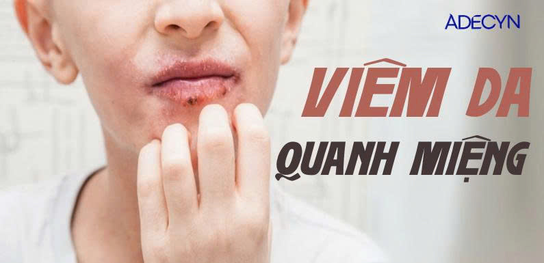 Viêm da quanh miệng