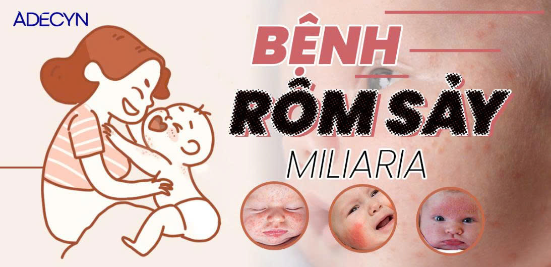 BỆNH RÔM SẢY (MILIARIA)