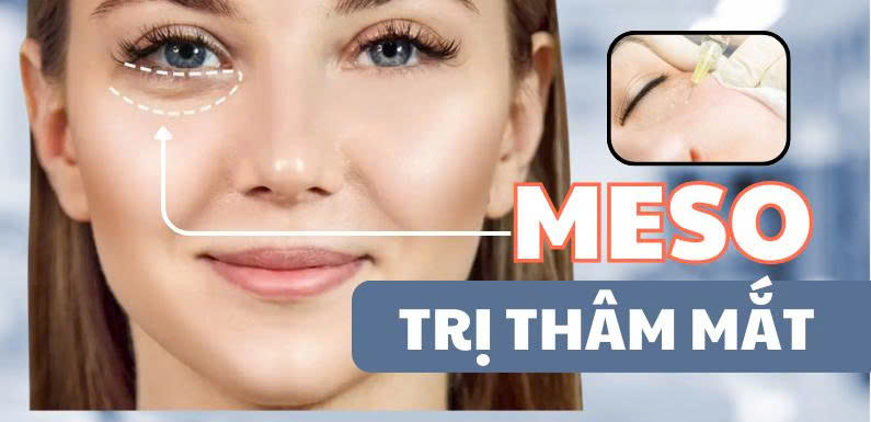 Meso trị thâm mắt