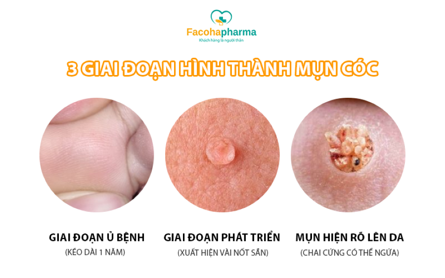 3 giai đoạn hình thành mụn cóc