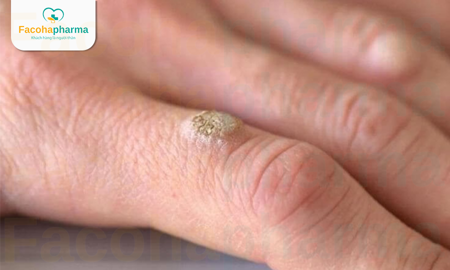 Biểu hiện của mụn cóc