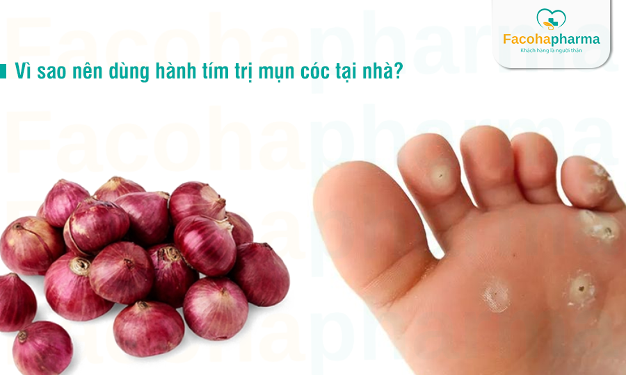 Lợi ích khi dùng hành tím trị mụn cóc