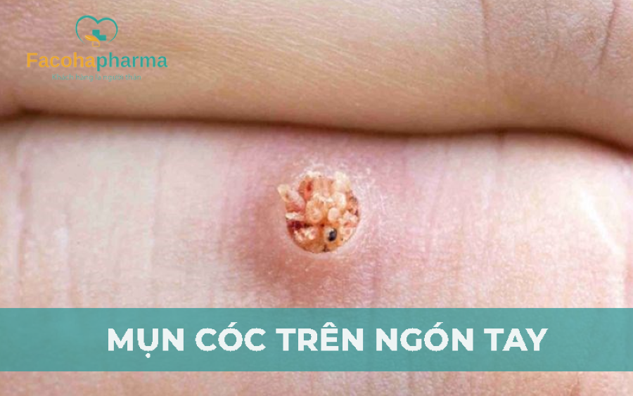 Mụn cóc trên ngón tay