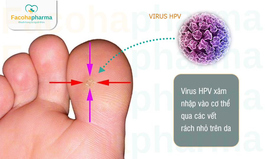Nguyên nhân gây bệnh mụn cóc