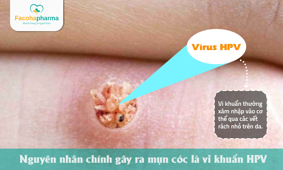 Nguyên nhân hình thành mụn cóc