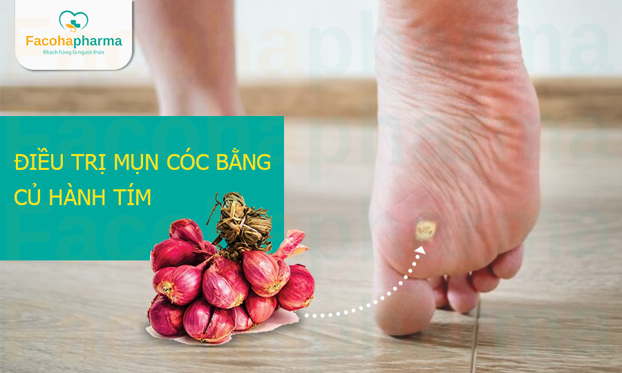 Trị mụn cóc bằng hành tím