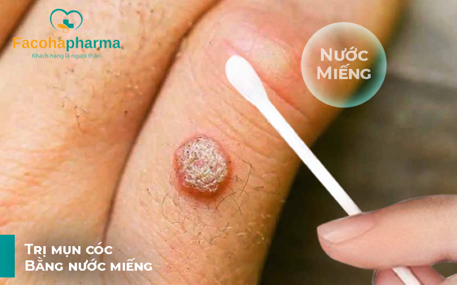 Trị mụn cóc bằng nước miếng