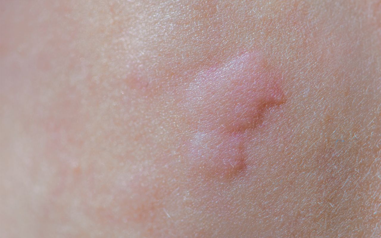 Mề Đay Dị Ứng Nên Ăn Gì? Thực Phẩm Giảm Triệu Chứng