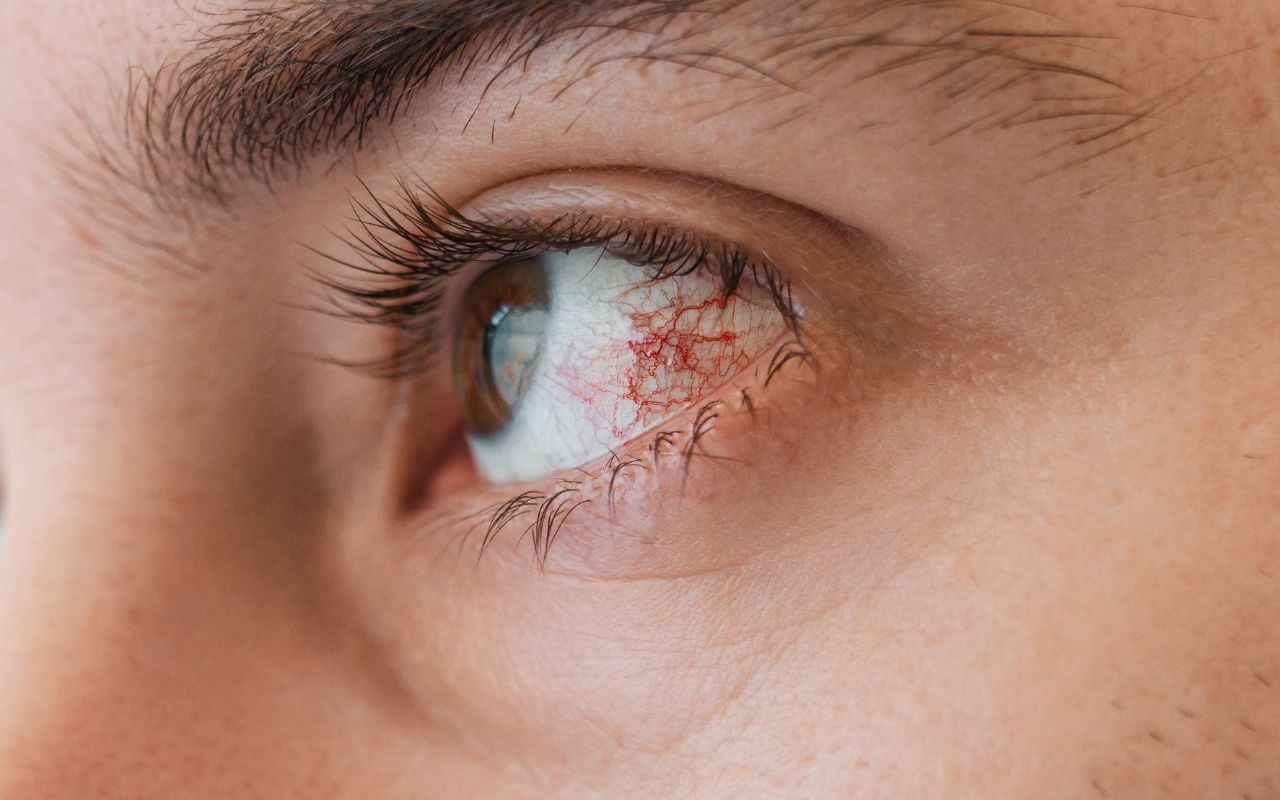 Viêm Giác Mạc Nên Ăn Gì? Chế Độ Ăn Hỗ Trợ Giảm Viêm và Tăng Cường Sức Khỏe Mắt