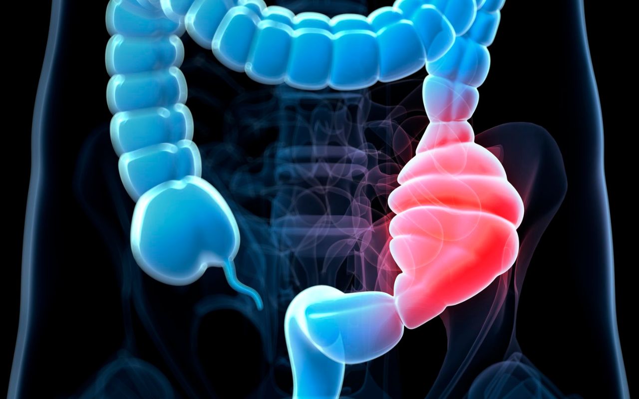 Ung Thư Đại Tràng Nên Ăn Gì? Thực Đơn Hỗ Trợ Phục Hồi