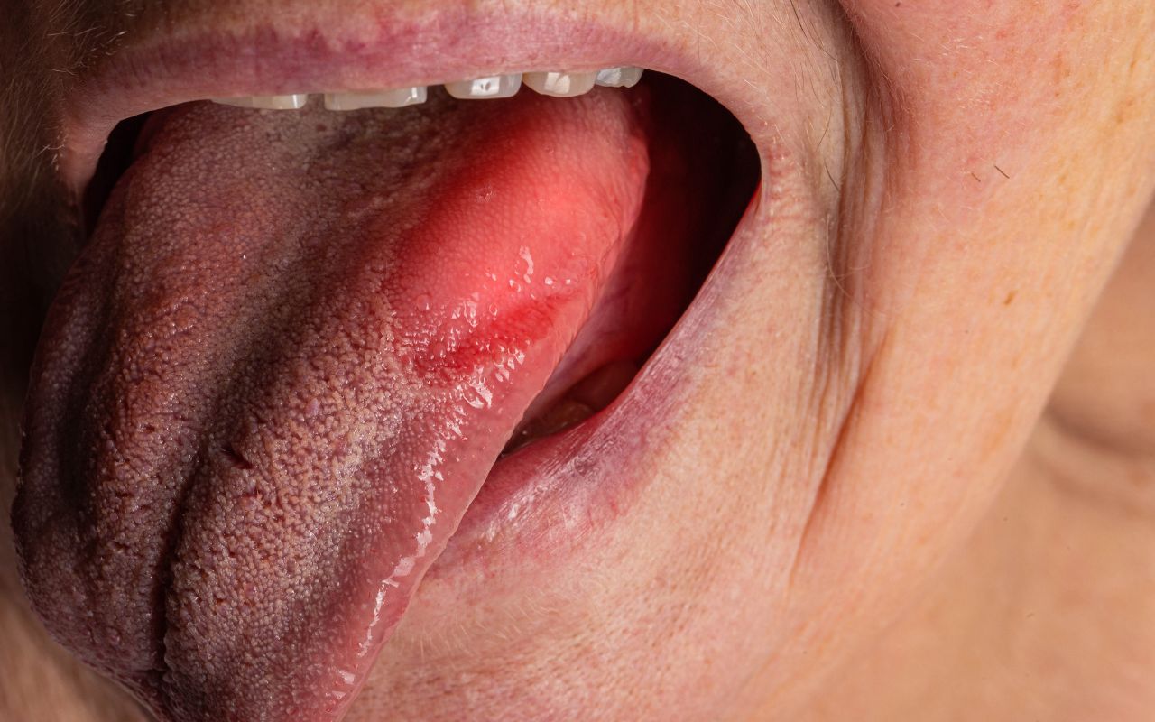 Viêm Lưỡi Nên Ăn Gì? Thực Phẩm Làm Dịu Viêm Lưỡi