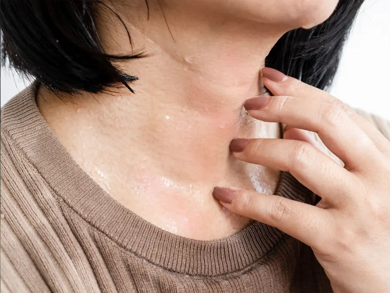 Dấu hiệu ra nhiều mồ hôi: Đổ mồ hôi nhiều ở tay, chân, mặt, nách, bẹn