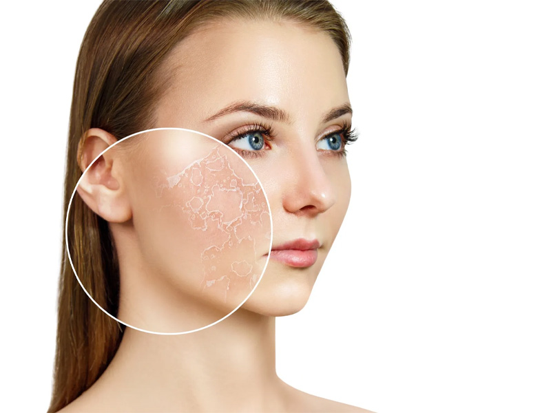 Tác hại của độ ẩm thấp: Gây khô da, nứt nẻ, kích ứng đường hô hấp