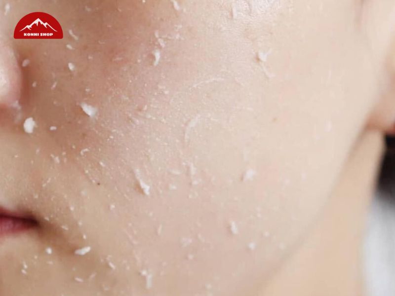 Giới thiệu về tẩy tế bào chết Rosette