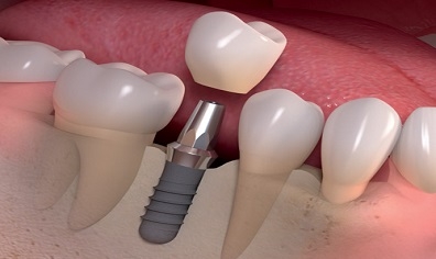 Cấy ghép Implant