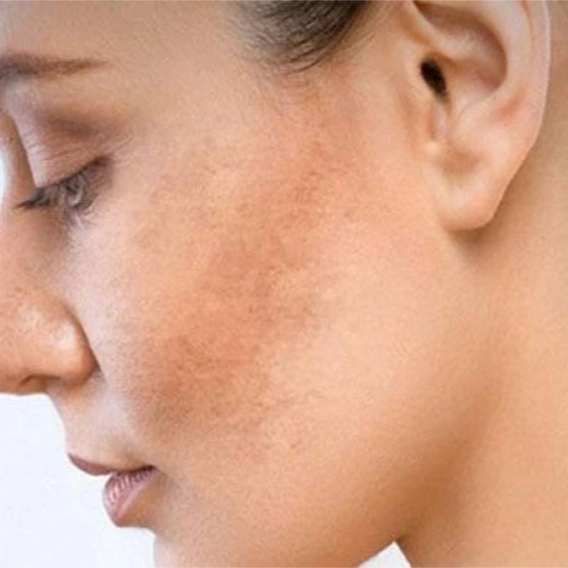 Sạm da do lão hóa và cách chăm sóc chuẩn bác sĩ da liễu