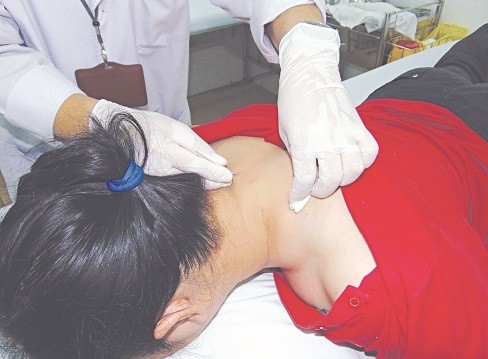 Điều trị thoái hóa - thoát vị cột sống cổ bằng nhu châm cấy chỉ