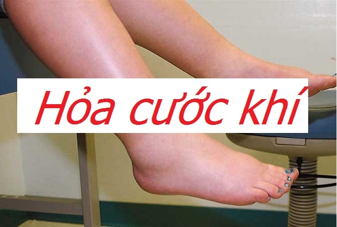 Các bài thuốc kinh nghiệm bệnh hỏa cước khí