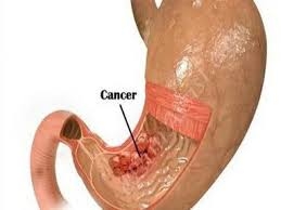 Triệu chứng của ung thư dạ dày bạn không nên chủ quan