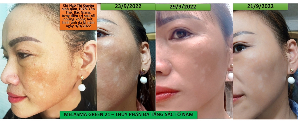 Melasma Green 21 Hỗ trợ trị nám hiệu quả công nghệ thủy phân đa tầng sắc tố tiên tiến từ Nhật Bản