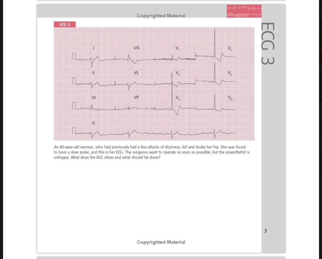 Sách ngoại văn 150 ECG Cases 5th