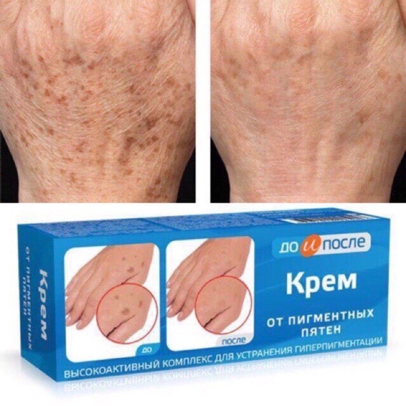 Kem Dưỡng Làm Mờ Phục Hồi Đốm Nâu Đồi Mồi Kpem Cream 50g