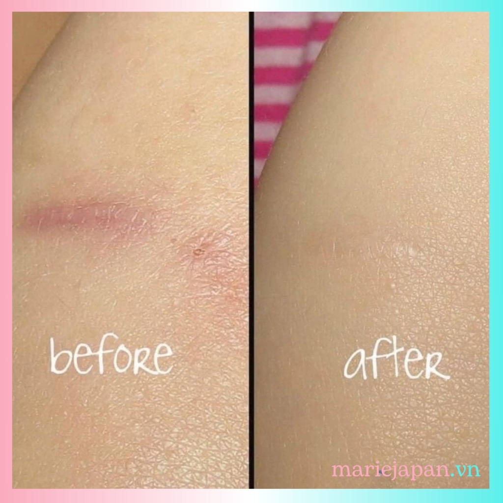 Kem Sẹo Gentacin Nhật Bản Tuýp 10g