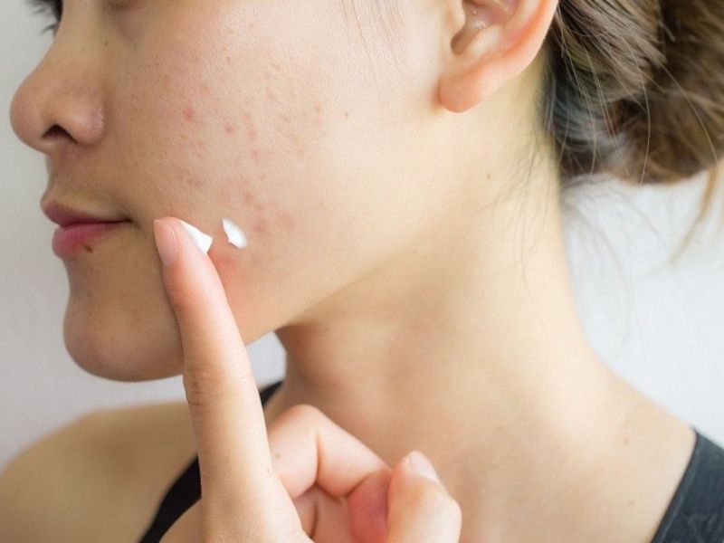 Chấm Mụn Klenzit CAdapalene + Clindamycin Phosphate Gel