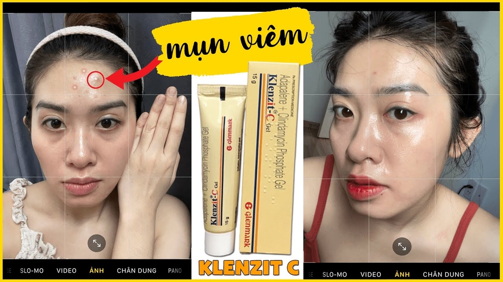Chấm Mụn Klenzit CAdapalene + Clindamycin Phosphate Gel