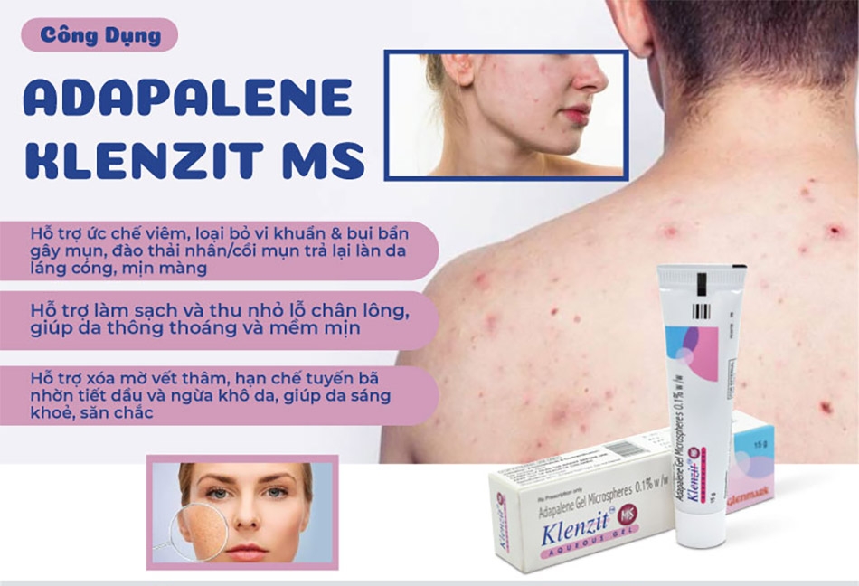Chấm Mụn Glenmark Pharma  Klenzit Ms Adapalene