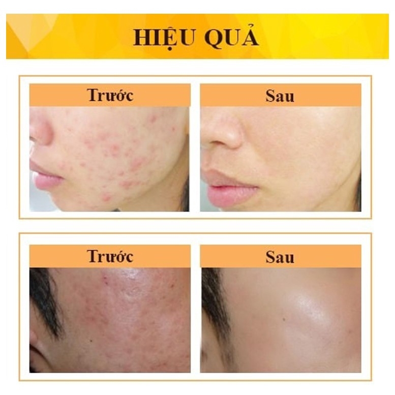 Chấm Mụn Gel Derma Forte