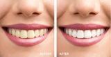 Chăm sóc sau khi tẩy trắng răng thế nào để duy trì kết quả lâu dài?