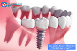 Cấy ghép răng Implant