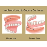 Implant-Nha Khoa