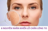Tất tật các nguyên nhân dẫn đến tình trạng lỗ chân lông to