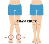 Giày chân chụm X / vòng kiềng O - mẫu nữ