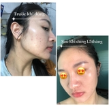 Gel trị mụn Klenzit C 15g