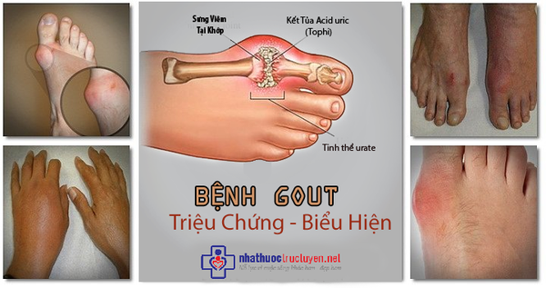 GOUT VÀ NHỮNG BIẾN CHỨNG NGUY HIỂM