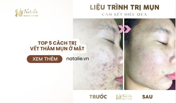 
			TOP 5 Cách Trị Vết Thâm Mụn Ở Mặt. Giải Pháp Trị Dứt Điểm Mụn Dai Dẳn
			
			
			 Natalie.vn			
		