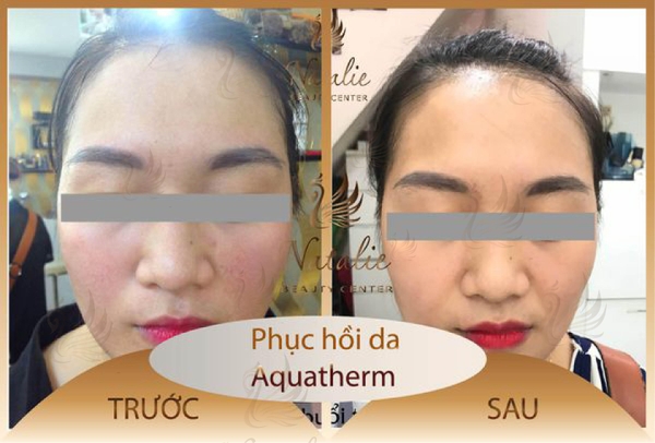 Hinh-anh-khach-hang-truoc-va-sau-qua-trinh-phuc-hoi-da