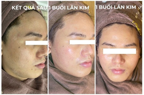 lan-kim-tri-tham-mun