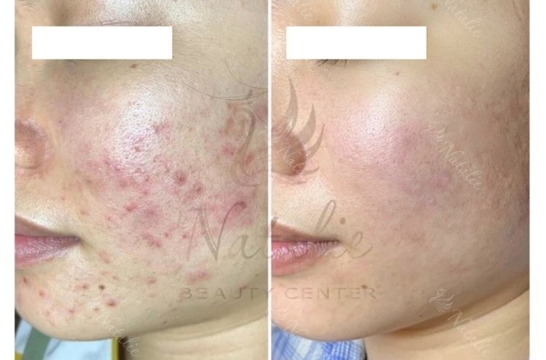 cach-dieu-tri-mun-viem