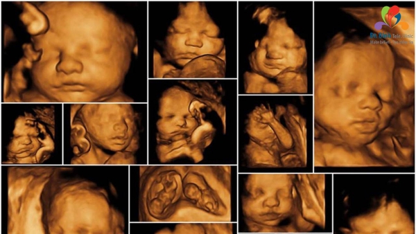 Siêu âm 4D thai 24 tuần: hình ảnh thai, cách đọc kết quả