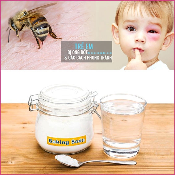 Ong Vàng Và Ong Vò Vẽ Đốt, 3 BƯỚC Sơ Cứu Khi Bị Ong Chích