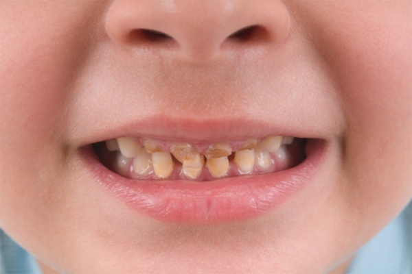 Răng sâu trẻ em và những vấn đề cần lưu ý