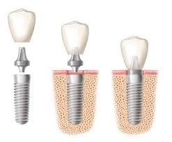 Ghép xương trong implant- Những điều cần biết