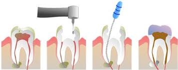 Điều trị nội nha