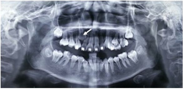 Xử trí răng mọc ngầm